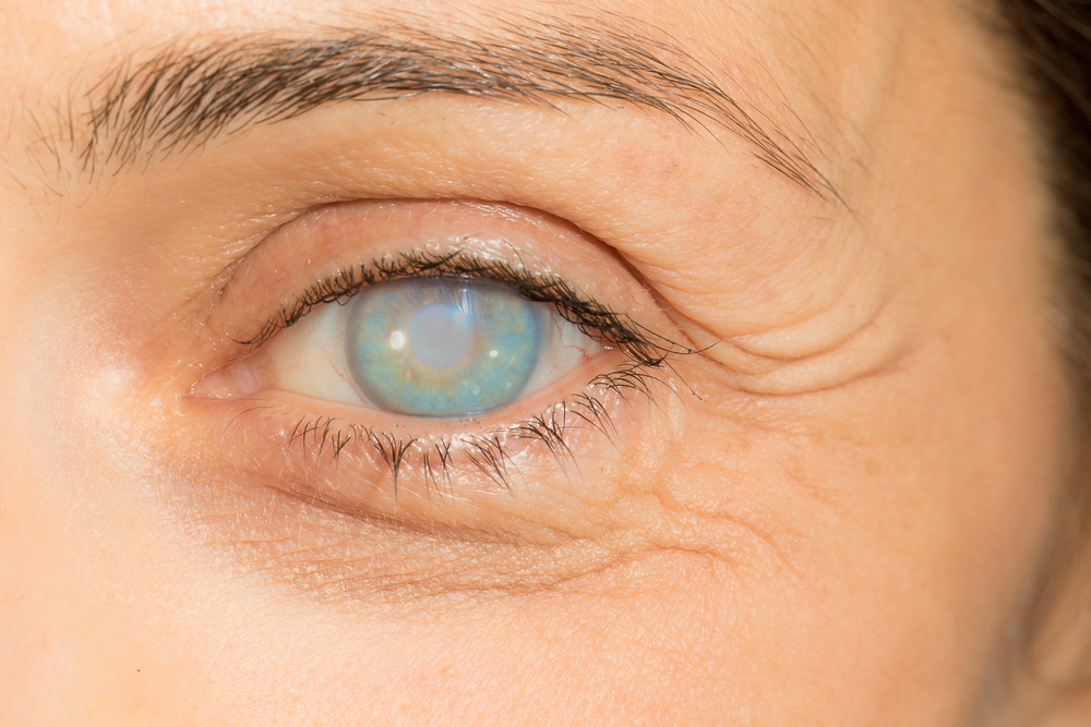 Detalle de un ojo de una persona ciega