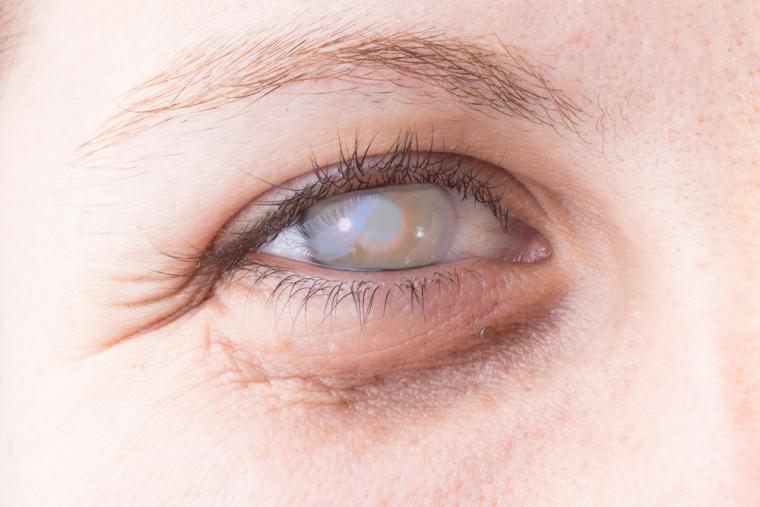 Imagen de un ojo con c&oacute;rnea opaca